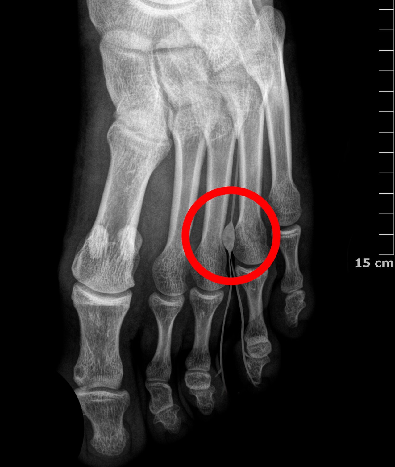 Morton’s Neuroma